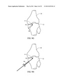 METHOD FOR TREATING JOINT PAIN AND ASSOCIATED INSTRUMENTS diagram and image