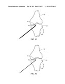 METHOD FOR TREATING JOINT PAIN AND ASSOCIATED INSTRUMENTS diagram and image