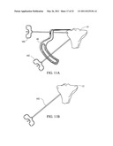 METHOD FOR TREATING JOINT PAIN AND ASSOCIATED INSTRUMENTS diagram and image