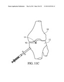 METHOD FOR TREATING JOINT PAIN AND ASSOCIATED INSTRUMENTS diagram and image