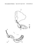 METHOD FOR TREATING JOINT PAIN AND ASSOCIATED INSTRUMENTS diagram and image