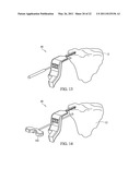 METHOD FOR TREATING JOINT PAIN AND ASSOCIATED INSTRUMENTS diagram and image