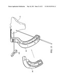 METHOD FOR TREATING JOINT PAIN AND ASSOCIATED INSTRUMENTS diagram and image