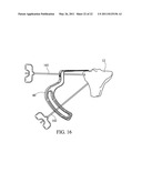 METHOD FOR TREATING JOINT PAIN AND ASSOCIATED INSTRUMENTS diagram and image