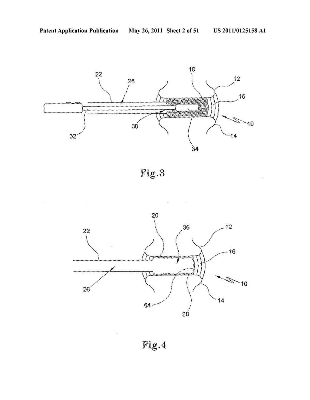 SYSTEMS, METHODS AND APPARATUSES FOR FORMATION AND INSERTION OF TISSUE PROSTHESES - diagram, schematic, and image 03