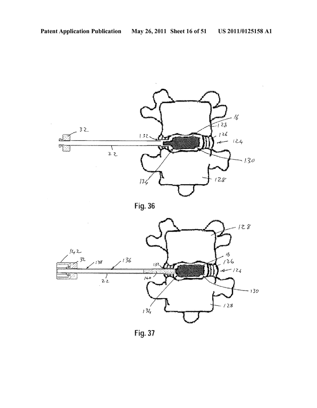 SYSTEMS, METHODS AND APPARATUSES FOR FORMATION AND INSERTION OF TISSUE PROSTHESES - diagram, schematic, and image 17