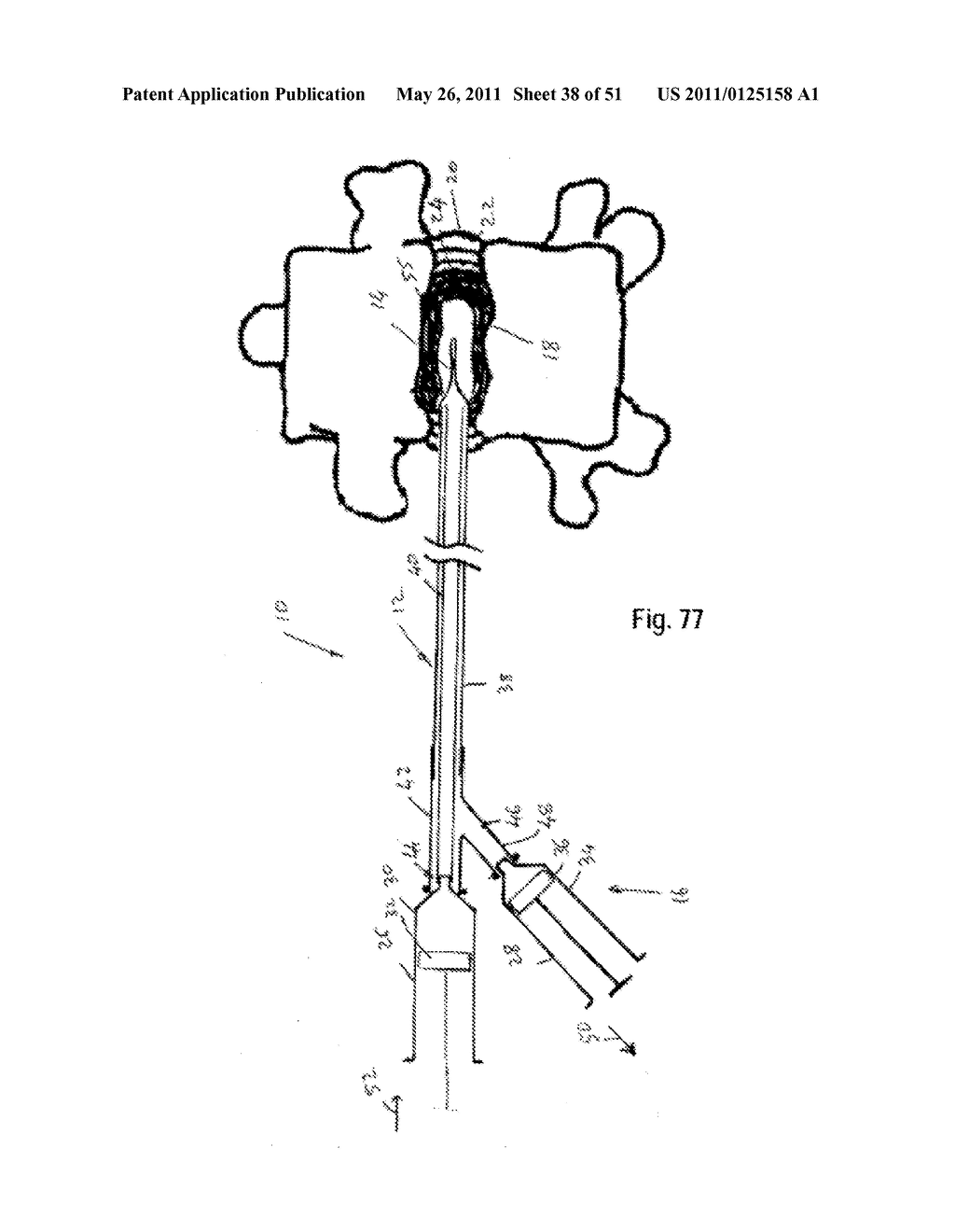 SYSTEMS, METHODS AND APPARATUSES FOR FORMATION AND INSERTION OF TISSUE PROSTHESES - diagram, schematic, and image 39