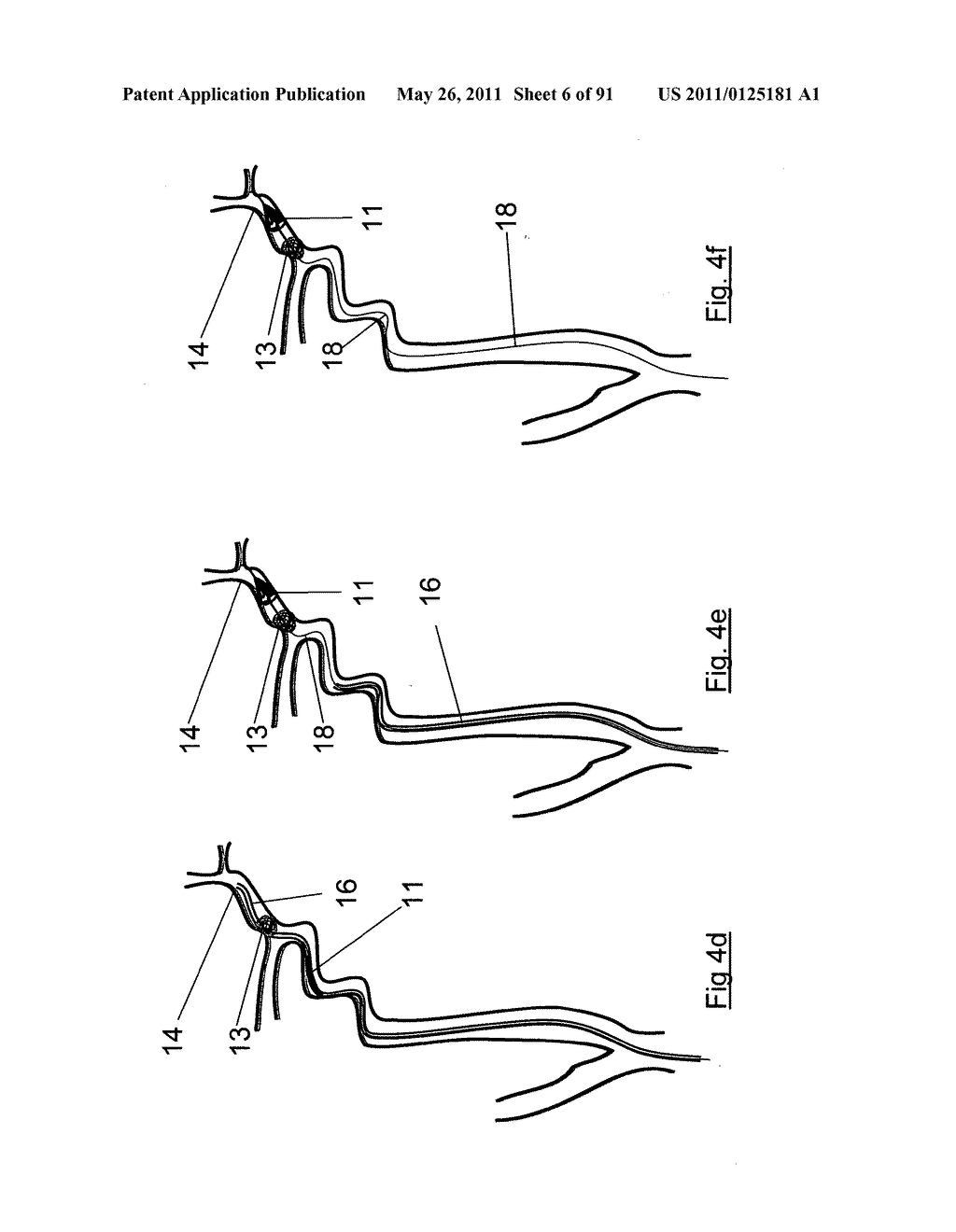 CLOT CAPTURE SYSTEMS AND ASSOCIATED METHODS - diagram, schematic, and image 07