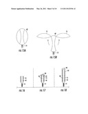 CAM Lock Pedicle Screw diagram and image