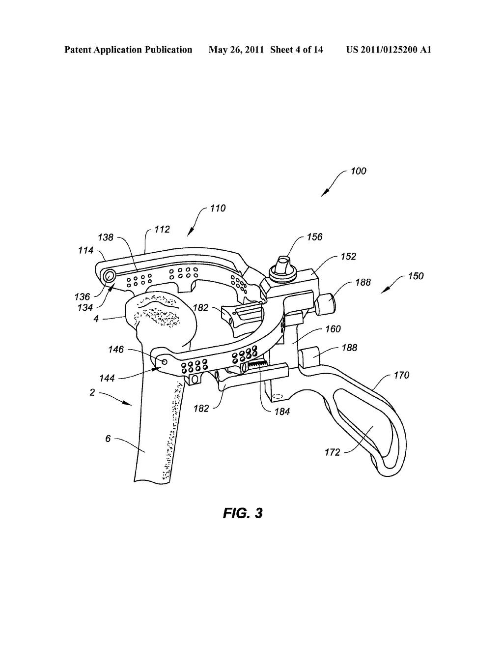 NAVIGATION AND POSITIONING INSTRUMENTS FOR JOINT REPAIR AND METHODS OF USE - diagram, schematic, and image 05