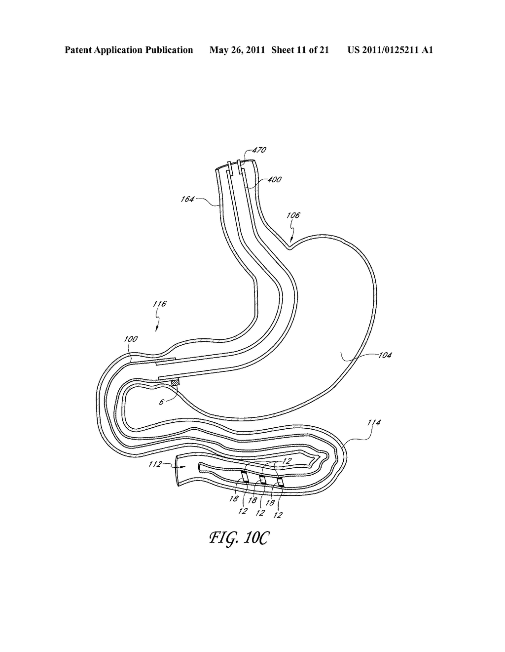 METHODS AND DEVICES FOR GASTROINTESTINAL STIMULATION - diagram, schematic, and image 12