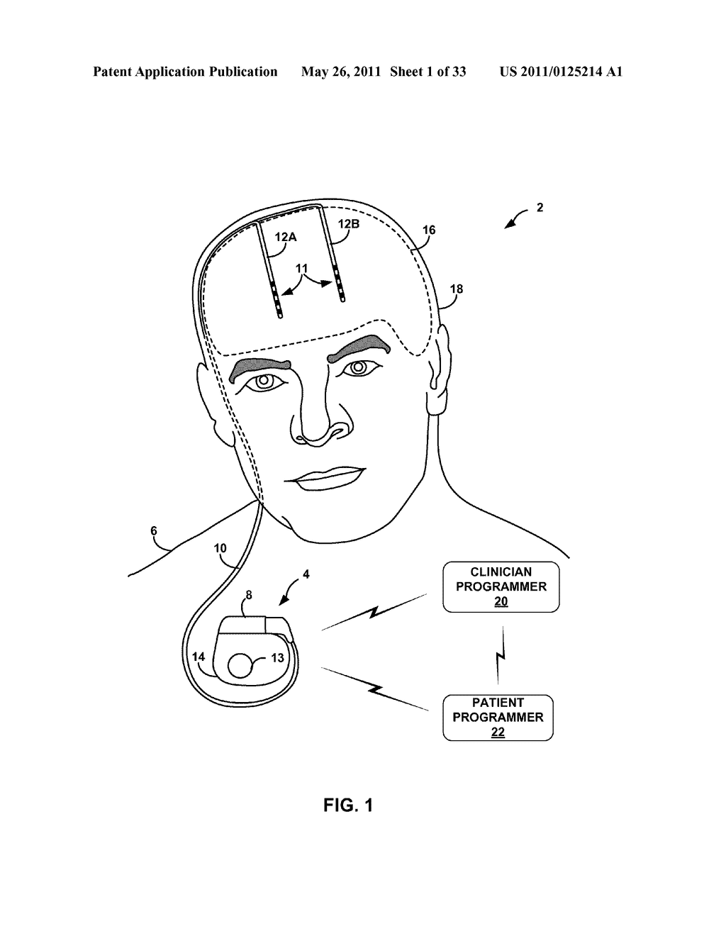 MEDICAL ELECTRICAL STIMULATION WITH EXTERNAL SIMULATED CASE ELECTRODE - diagram, schematic, and image 02