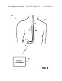 MEDICAL ELECTRICAL STIMULATION WITH EXTERNAL SIMULATED CASE ELECTRODE diagram and image