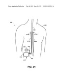 MEDICAL ELECTRICAL STIMULATION WITH EXTERNAL SIMULATED CASE ELECTRODE diagram and image