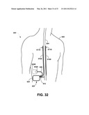 MEDICAL ELECTRICAL STIMULATION WITH EXTERNAL SIMULATED CASE ELECTRODE diagram and image