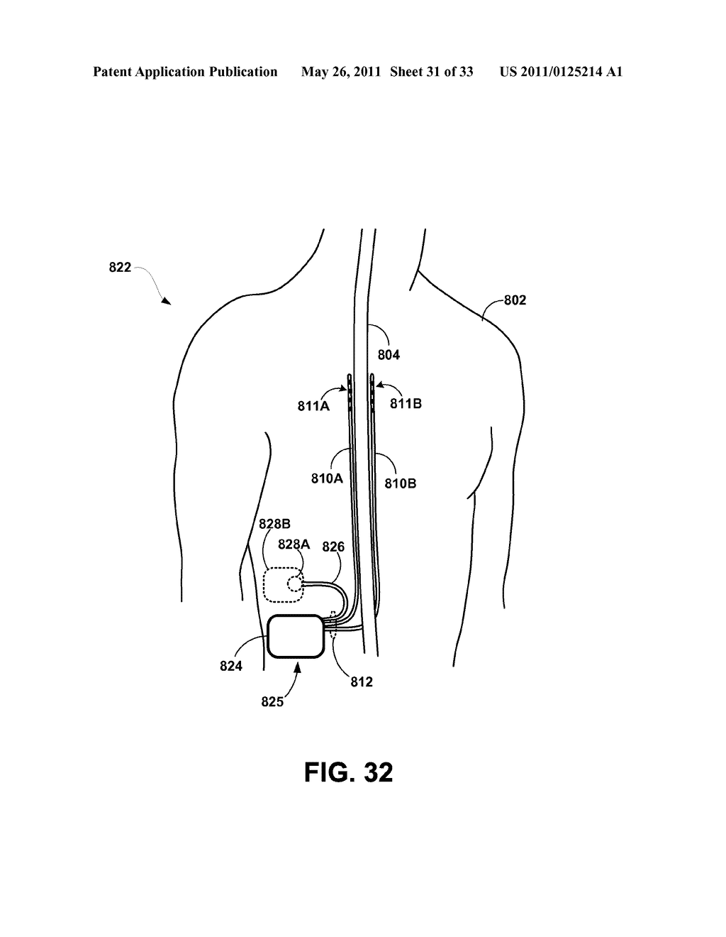 MEDICAL ELECTRICAL STIMULATION WITH EXTERNAL SIMULATED CASE ELECTRODE - diagram, schematic, and image 32