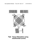 INTERFERENTIAL NON INVASIV TEMPORARY PACER diagram and image