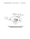 INTERFERENTIAL NON INVASIV TEMPORARY PACER diagram and image