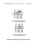 INTERFERENTIAL NON INVASIV TEMPORARY PACER diagram and image