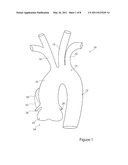 Stent Graft and Introducer Assembly diagram and image