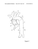 Stent Graft and Introducer Assembly diagram and image