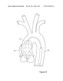 Stent Graft and Introducer Assembly diagram and image