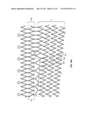 Self-Expanding Stent with Polygon Transition Zone diagram and image