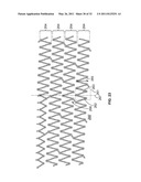 Self-Expanding Stent with Polygon Transition Zone diagram and image