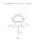 METHOD OF PERFORMING AN ANCHOR IMPLANTATION PROCEDURE WITHIN A DISC diagram and image