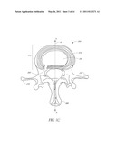 METHOD OF PERFORMING AN ANCHOR IMPLANTATION PROCEDURE WITHIN A DISC diagram and image