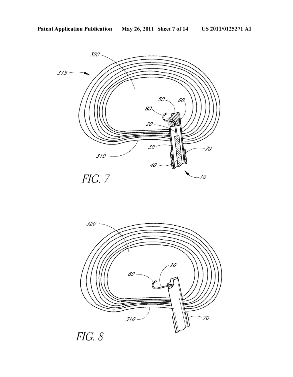 METHOD OF PERFORMING AN ANCHOR IMPLANTATION PROCEDURE WITHIN A DISC - diagram, schematic, and image 08