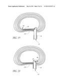 METHOD OF PERFORMING AN ANCHOR IMPLANTATION PROCEDURE WITHIN A DISC diagram and image