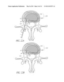 METHOD OF PERFORMING AN ANCHOR IMPLANTATION PROCEDURE WITHIN A DISC diagram and image