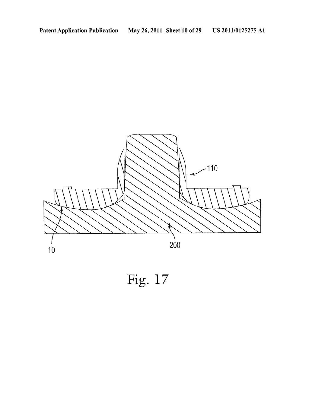 PROSTHETIC CONDYLAR JOINTS WITH ARTICULATING BEARING SURFACES HAVING A TRANSLATING CONTACT POINT DURING ROTATION THEREOF - diagram, schematic, and image 11