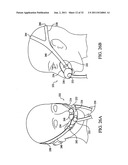 PATIENT INTERFACE DEVICE diagram and image