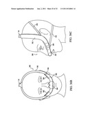 PATIENT INTERFACE DEVICE diagram and image