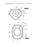 Tooth Implant diagram and image