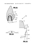 Tooth Implant diagram and image