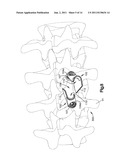 PATIENT-MOUNTED RETRACTION diagram and image