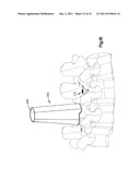 PATIENT-MOUNTED RETRACTION diagram and image