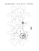 PATIENT-MOUNTED RETRACTION diagram and image