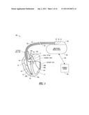 SELF-ADJUSTING ECG MORPHOLOGICAL FEATURE CORRELATION THRESHOLD diagram and image