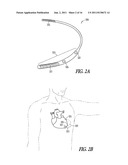 SELF-ADJUSTING ECG MORPHOLOGICAL FEATURE CORRELATION THRESHOLD diagram and image