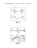 SELF-ADJUSTING ECG MORPHOLOGICAL FEATURE CORRELATION THRESHOLD diagram and image