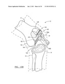 Method for Less Invasive Knee Resection diagram and image