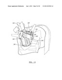 Method for Less Invasive Knee Resection diagram and image