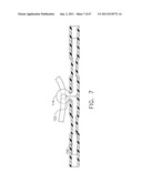 Device For Deploying A Fastener For Use In A Gastric Volume Reduction     Prodecure diagram and image