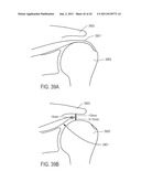 METHODS FOR CONTINUOUS SUTURE PASSING diagram and image