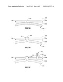 Ventral Hernia Repair With Barbed Suture diagram and image