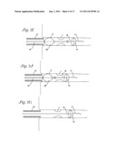 CATHETER WITH OCCLUDING CUFF diagram and image